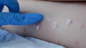 Erupciones provocadas por la viruela del mono./ Cedida