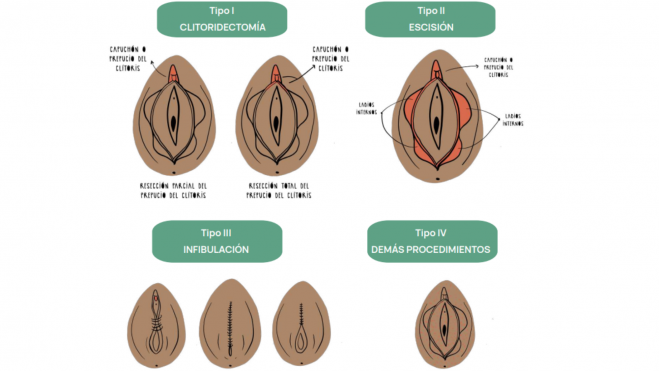 Tipos de mutilación genital femenina./ ICI