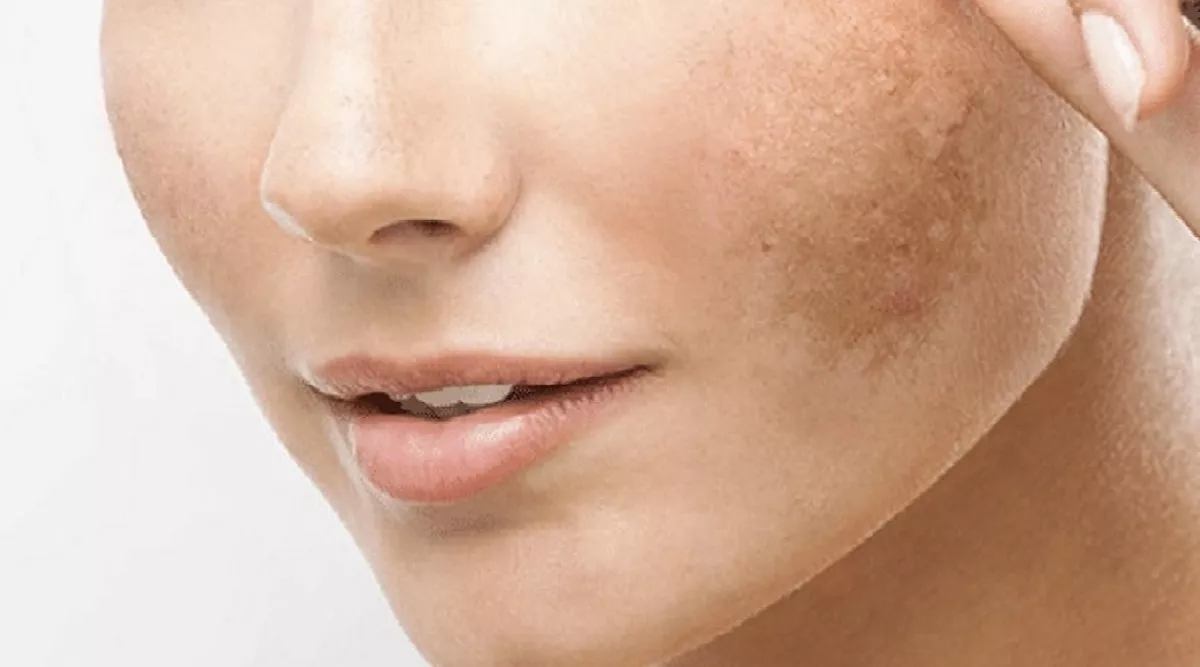 Las manchas en la piel aparecen tras una larga exposición al sol / EP