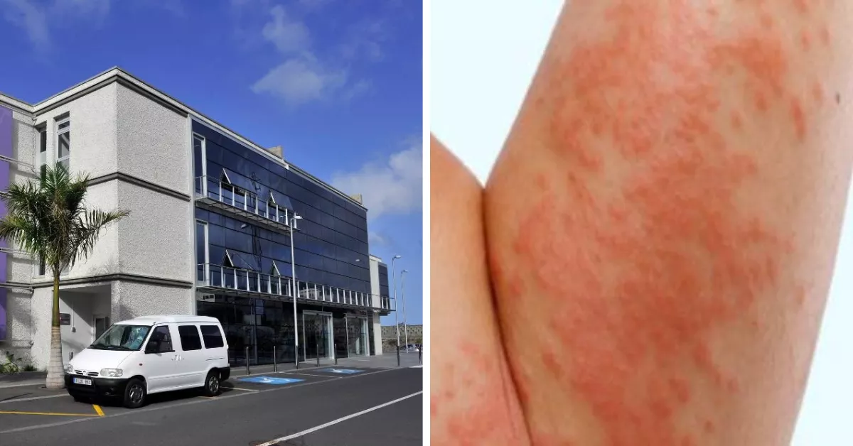 El Hospital La Santísima Trinidad de Icod de los Vinos, del IASS, y una imagen de archivo de un brazo infestado de sarna./ MONTAJE AH