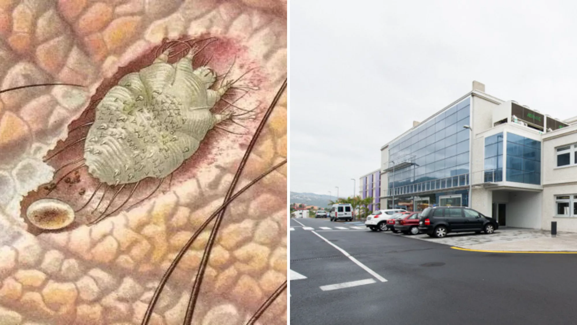 Un ácaro arador de la sarna y el hospital del IASS La Santísima Trinidad, en Icod de los Vinos./ MONTAJE AH Un ácaro arador de la sarna y el hospital del IASS La Santísima Trinidad, en Icod de los Vinos./ MONTAJE AH