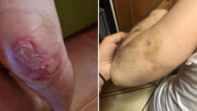 En la primera imagen una quemadura en la rodilla y en la segunda un moratón en la zona del codo de una usuaria del centro sociosanitario de Las LonguerasMONTAJE AH