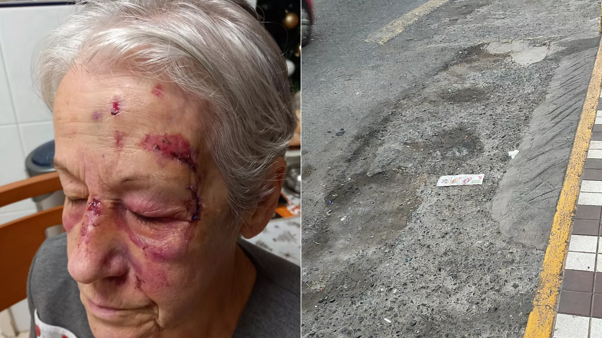 Vecina de Almatriche Bajo con heridas tras caerse por la falta de aceras en el barrio y el mal estado del pavimento / CEDIDAS