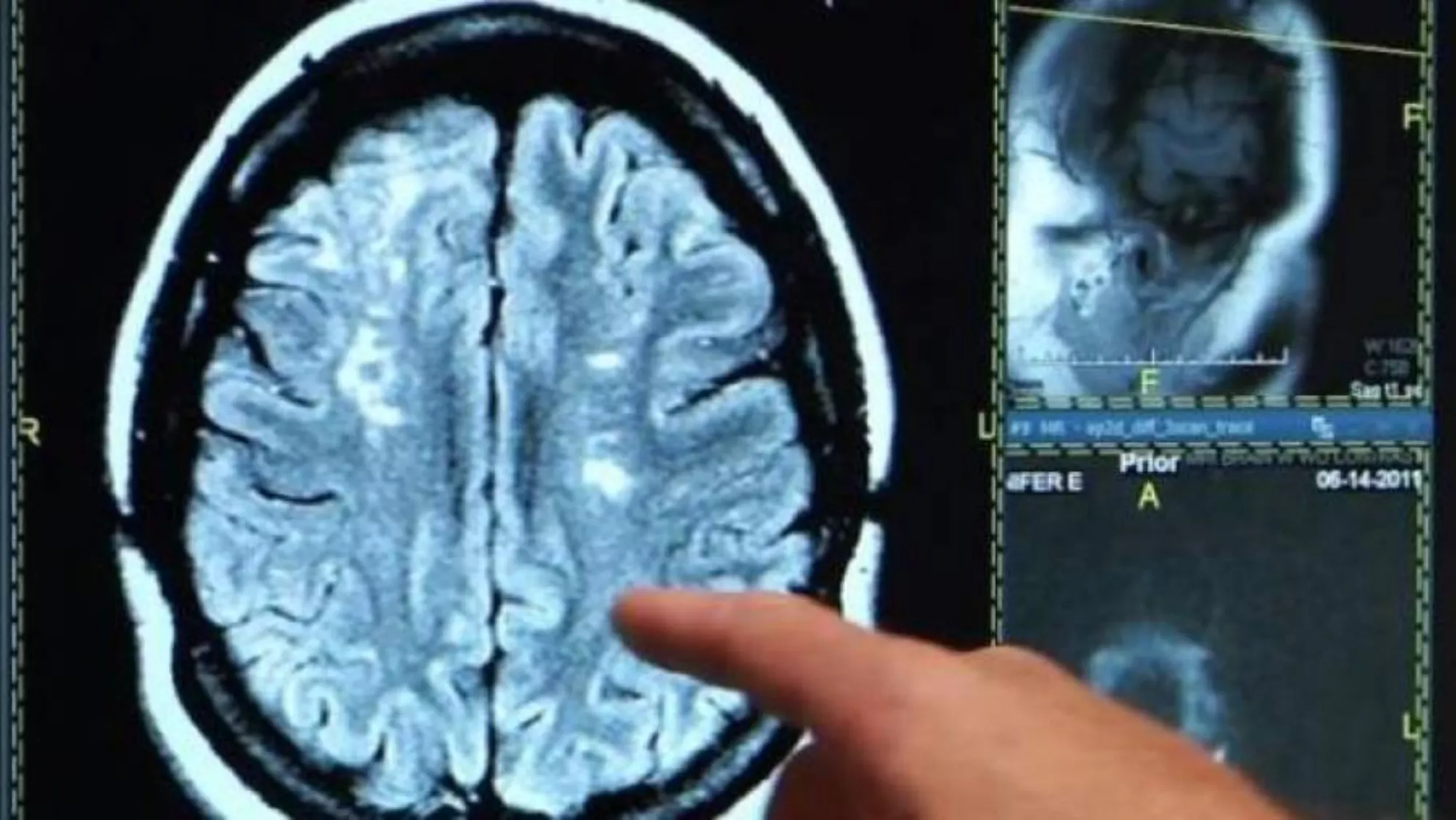 El ictus isquémico, que representa el 85% de los casos de ictus / EFE