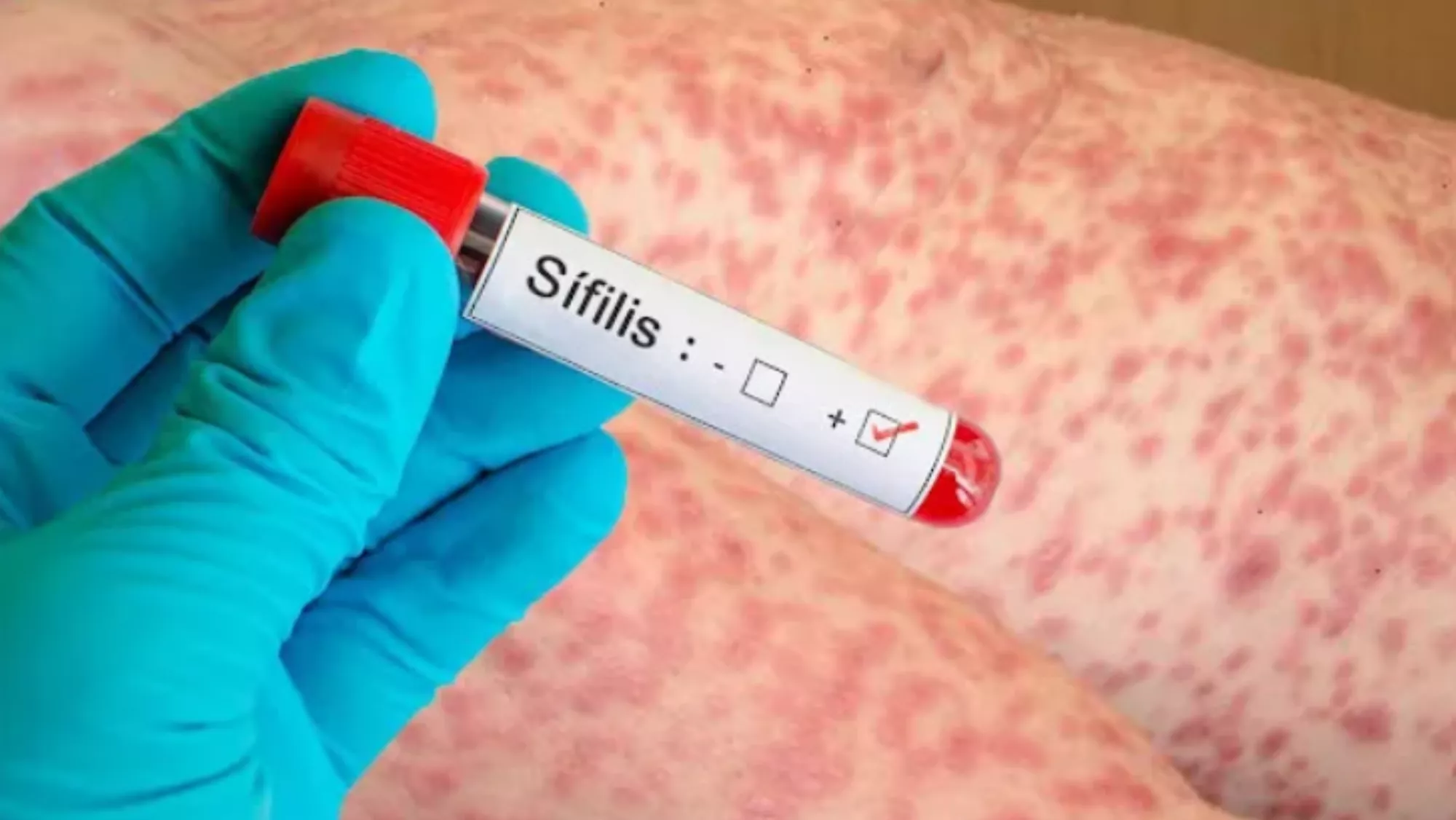 Positivo en Sífilis./ ARCHIVO