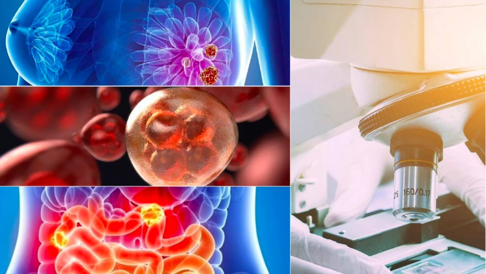 Montaje con imágenes de simulaciones de órganos afectados y tratamientos médicos de cánceres / SERVIMEDIA