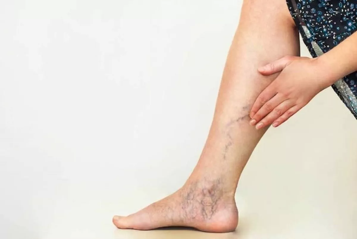 Una mujer muestra las varices en su pierna / EUROPA PRESS