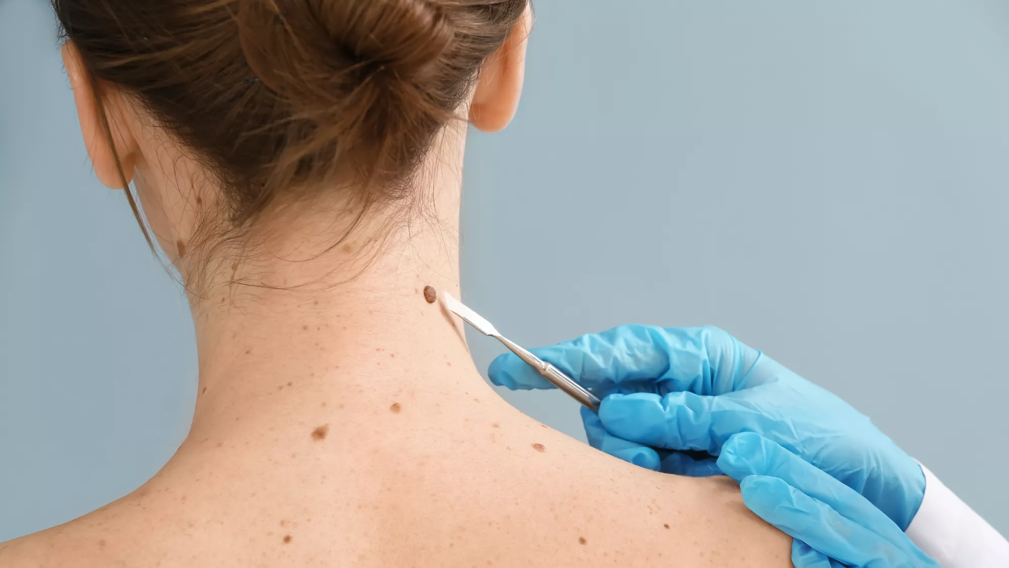 Imagen de una revisión del dermatólogo para prevenir el cáncer de piel / AH