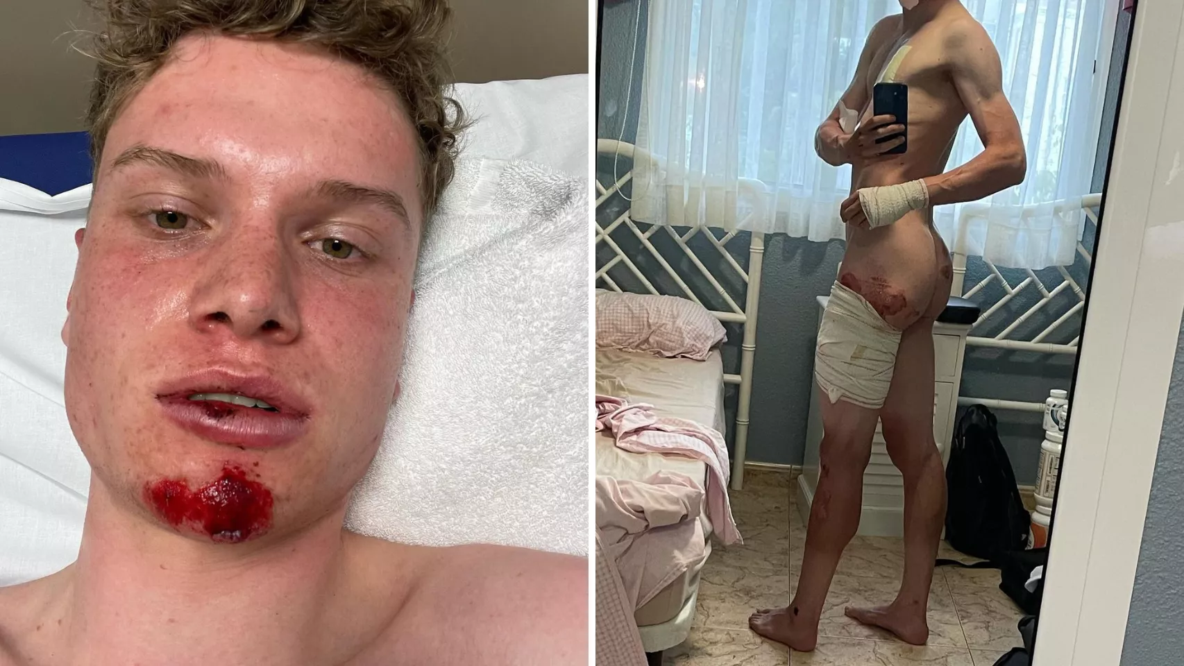 El ciclista belga Lennert Van Eetvelt muestra las heridas que ha sufrido tras ser atropellado en Tenerife./ Lennert Van Eetvelt