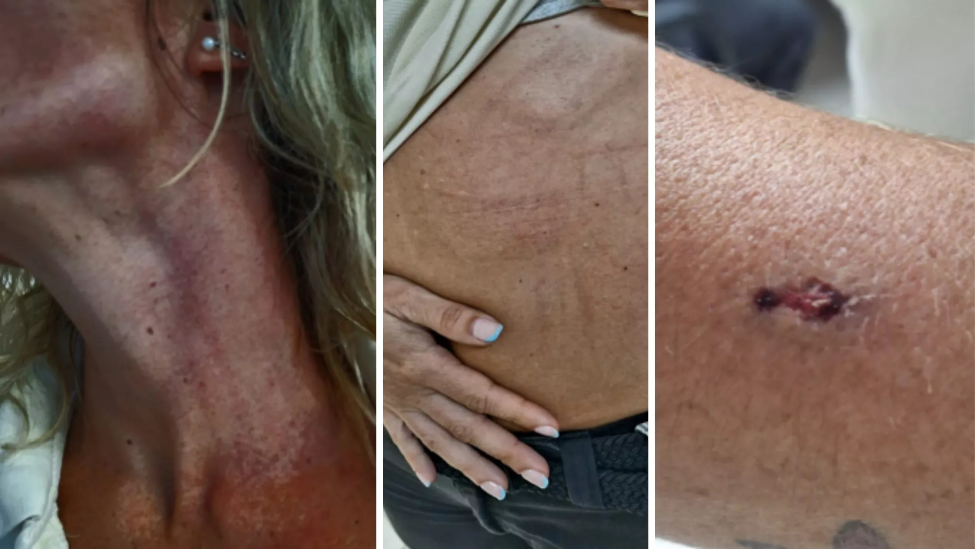 Lesiones sufridas por las funcionarias de prisiones / CEDIDA