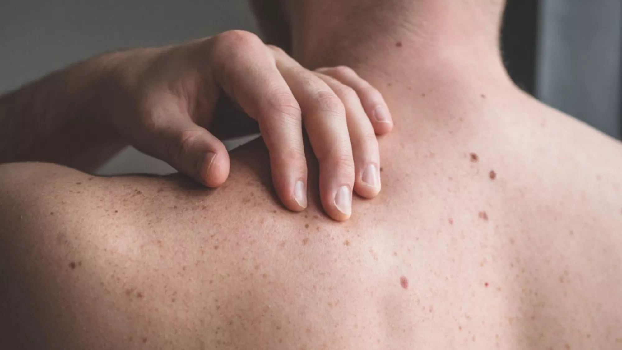 Las personas que han padecido cáncer de piel corren el riesgo de volver a padecerlo / EFE