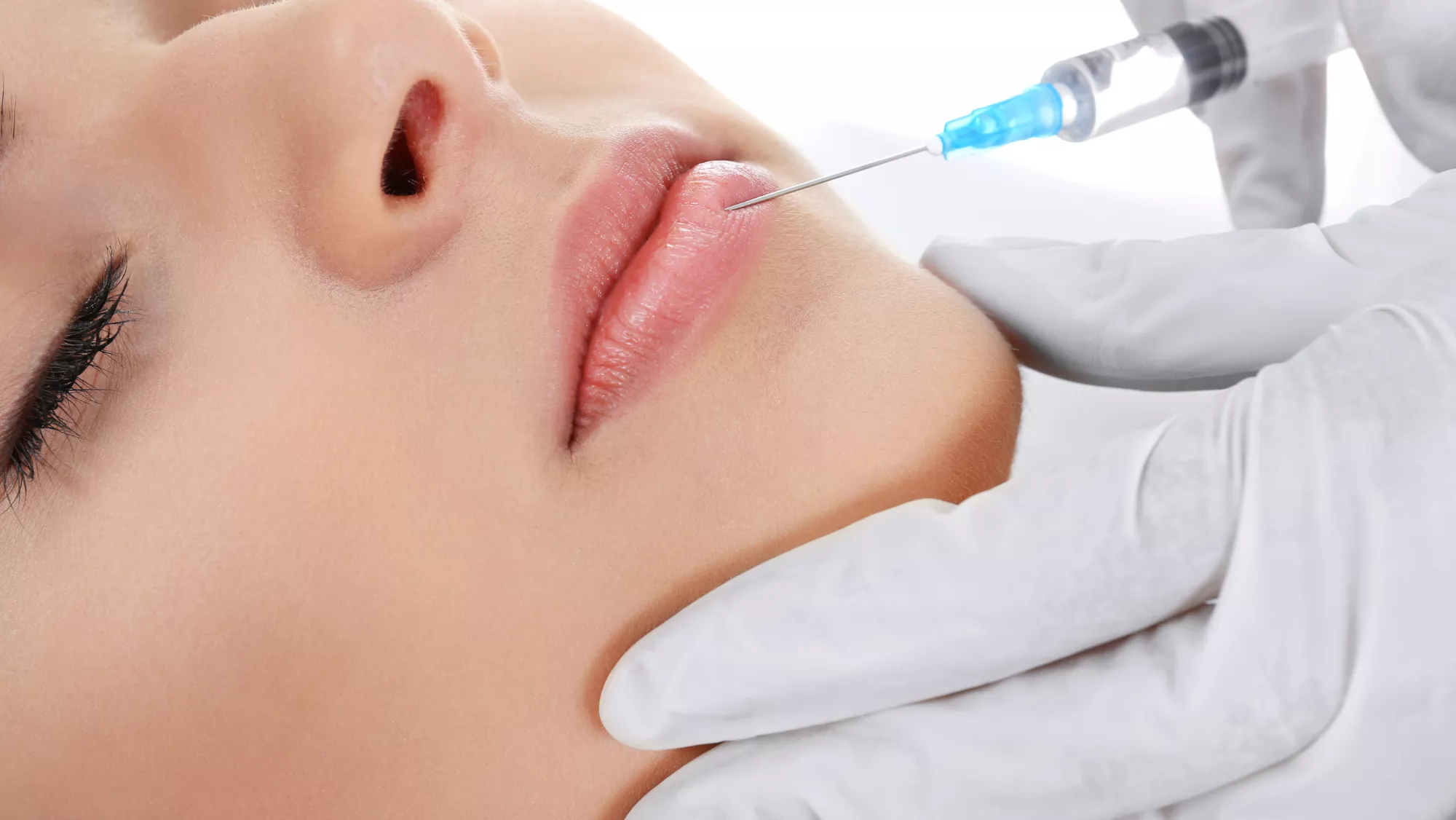 Imagen de infiltración de ácido hialurónico en los labios / AH