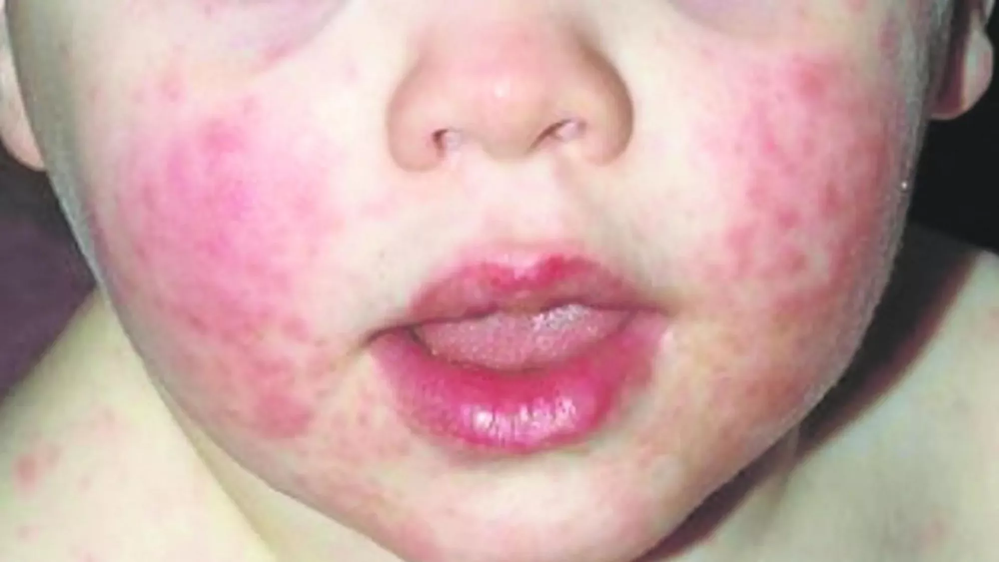 'Virus de la bofetada' o parvovirus B19, una enfermedad infantil caracterizada por enrojecimiento en las mejillas que se ha detectado en un colegio de Canarias./ ARCHIVO