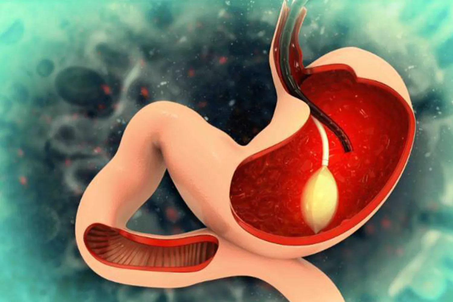 Reproducción de un balón gástrico en el interior de un estómago. La obesidad puede ser un problema si no se trata / QUIRÓNSALUD
