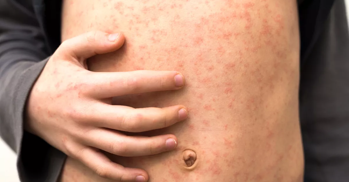Imagen de una persona con el sarampión / AH