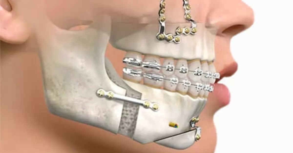 Recreación de una cirugía ortognática./ CLÍNICA BIRBE