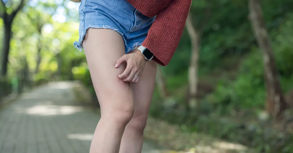 Imagen de una persona con una picada de mosquito como el que porta el virus / AH Imagen de una persona con una picada de mosquito como el que porta el virus / AH