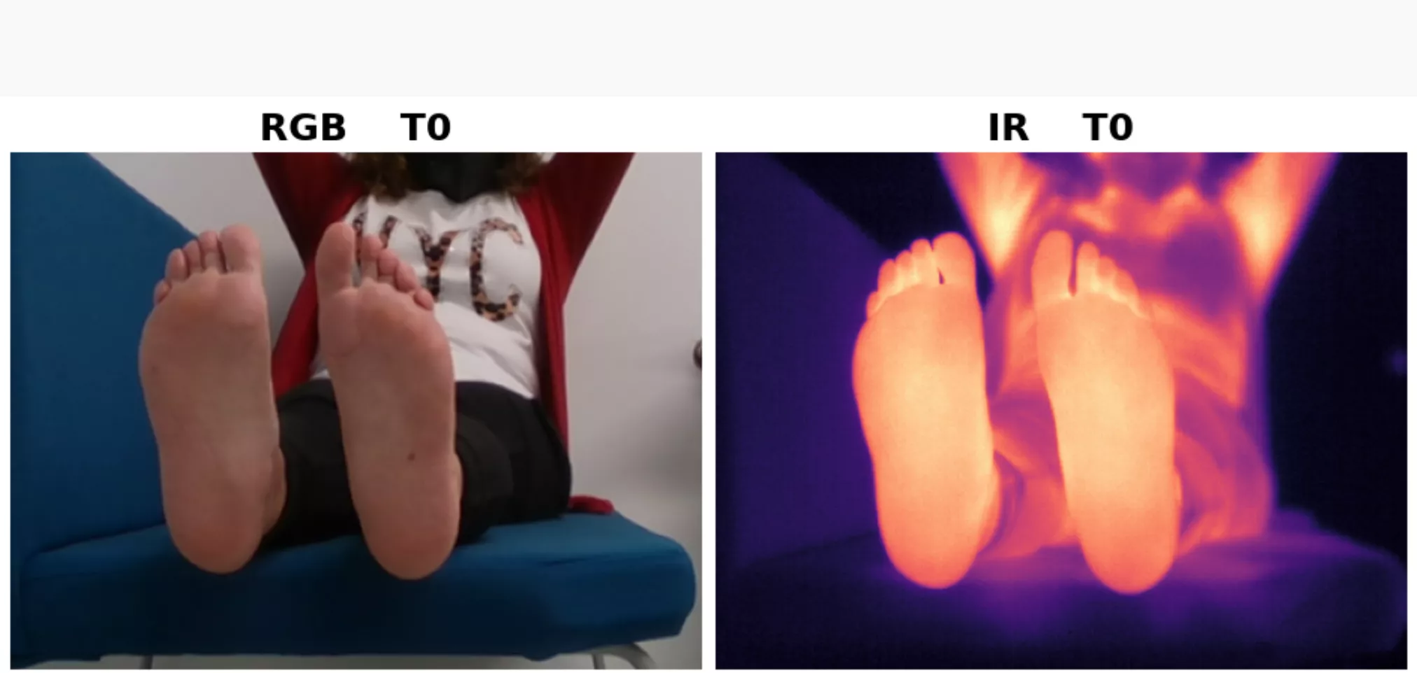 Estudio sobre el pie diabético./ IAC