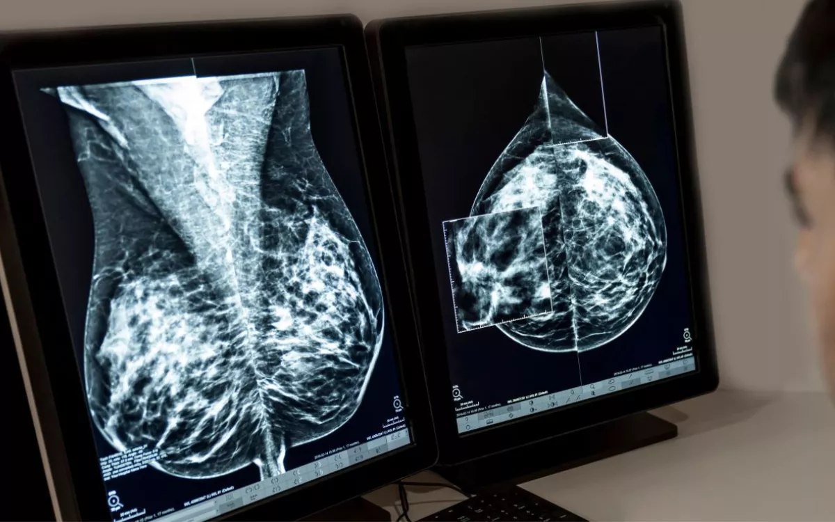 La Comisión Europea aprueba Kisqali de Novartis para pacientes con cáncer de mama localizado HR+/HER2- con alto riesgo de recaída. / SERVIMEDIA