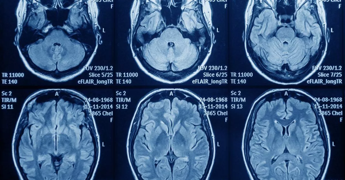 Resonancia magnética del cerebro. La asociación Astuce reclama un tratamiento efectivo para los pacientes con glioblastoma. | Foto de 123rf/akifyevasvetlana
