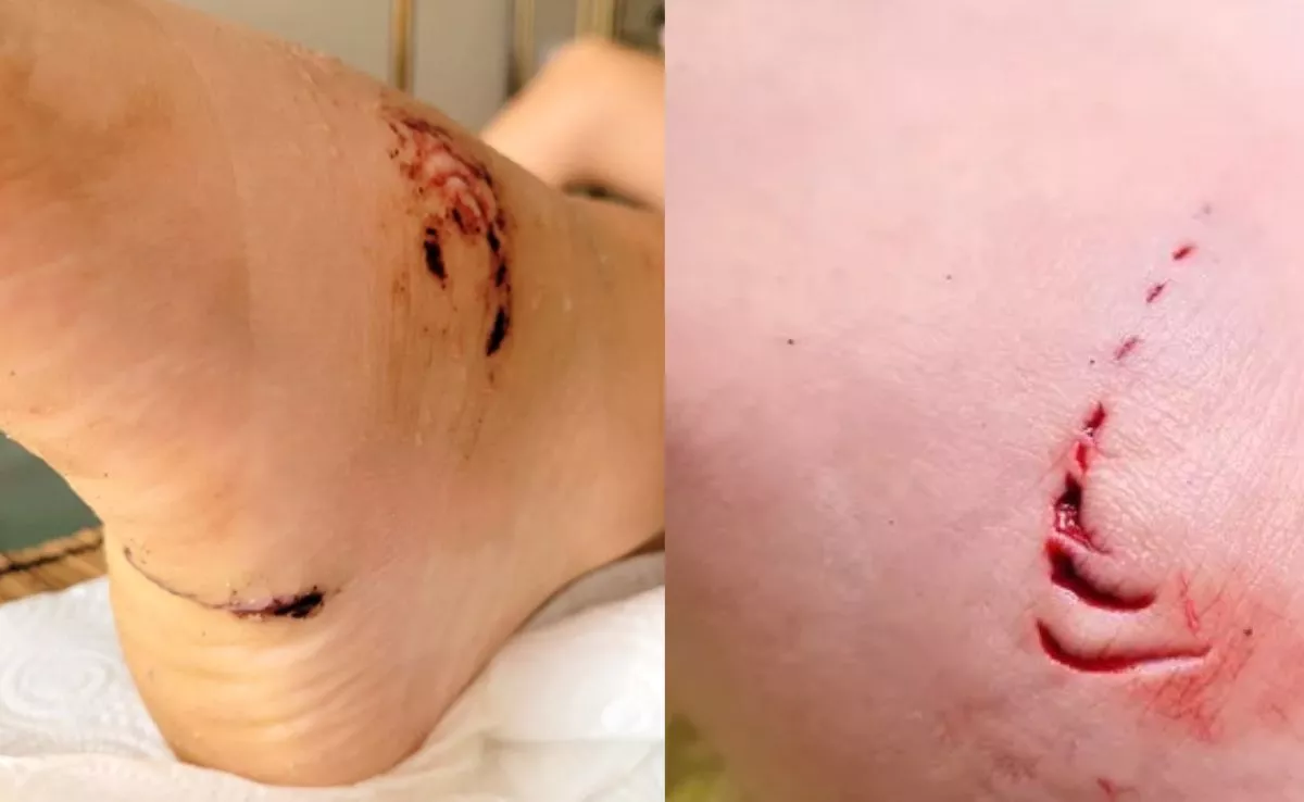 Susto en Las Canteras: un joven mordido por un tiburón