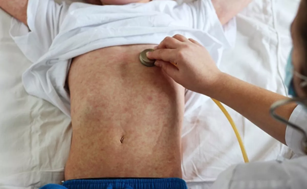 Menor contagiado con sarampión. 