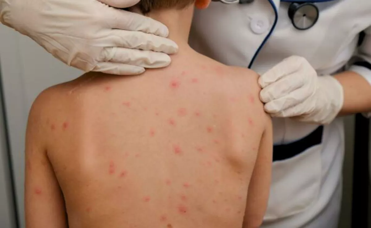 Imagen de un niño con sarampión / AH