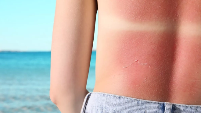 Imagen de una persona quemada al sol / CANVA