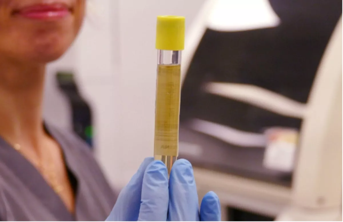 Muestra de orina, una de las pruebas para la detección de la enfermedad renal crónica / EUROPA PRESS Muestra de orina, una de las pruebas para la detección de la enfermedad renal crónica / EUROPA PRESS